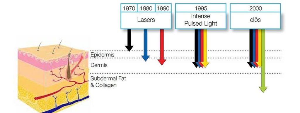 skin rejuvenation IPL